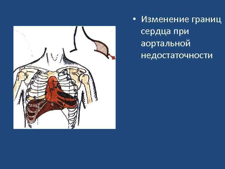  • Изменение границ сердца при аортальной недостаточности 