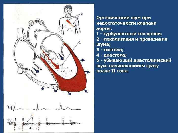 Органический шум при недостаточности клапана аорты. I - турбулентный ток крови; 2 - локализация