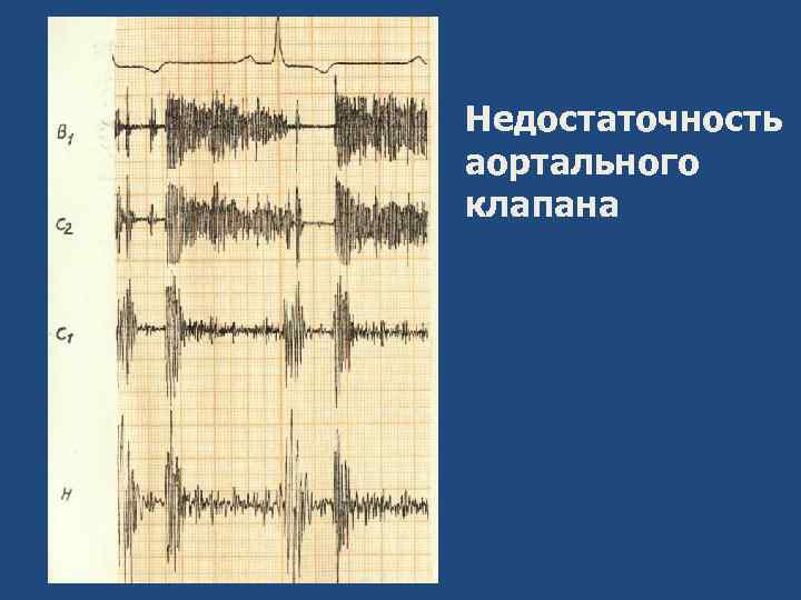 Недостаточность аортального клапана 