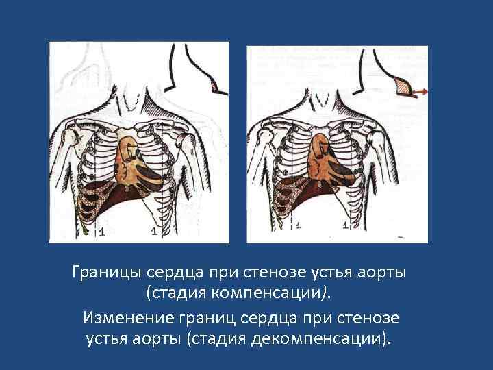 Границы сердца при стенозе устья аорты (стадия компенсации). Изменение границ сердца при стенозе устья