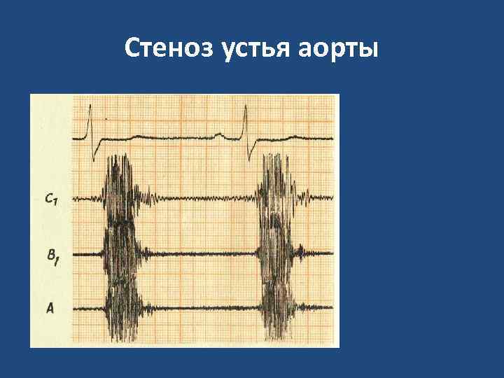 Стеноз устья аорты 