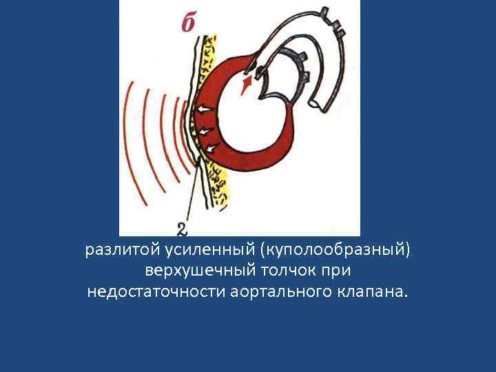 разлитой усиленный (куполообразный) верхушечный толчок при недостаточности аортального клапана. 