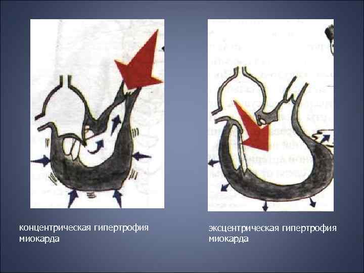 концентрическая гипертрофия миокарда эксцентрическая гипертрофия миокарда 