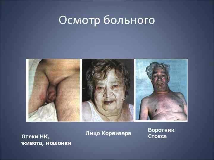 Осмотр больного Отеки НК, живота, мошонки Лицо Корвизара Воротник Стокса 