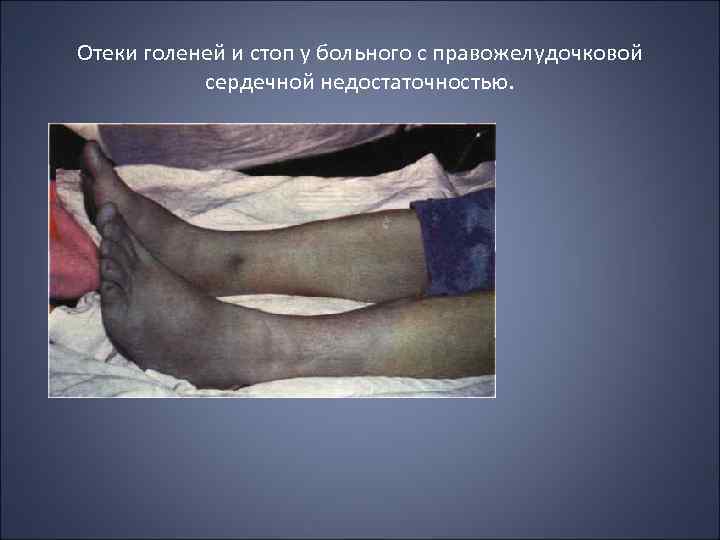 Отеки голеней и стоп у больного с правожелудочковой сердечной недостаточностью. 