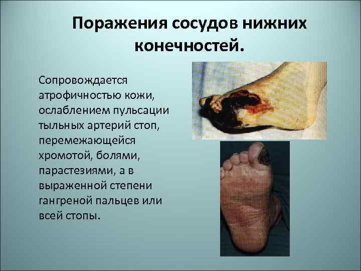 Поражения сосудов нижних конечностей. Сопровождается атрофичностью кожи, ослаблением пульсации тыльных артерий стоп, перемежающейся хромотой,