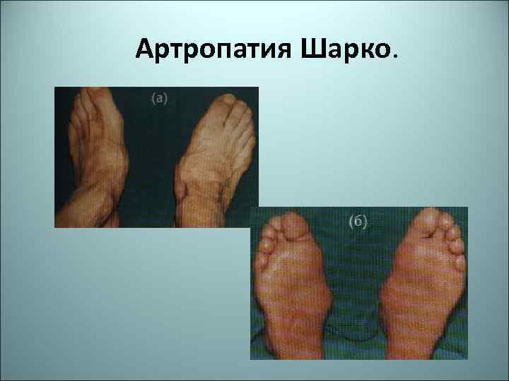 Артропатия Шарко. 