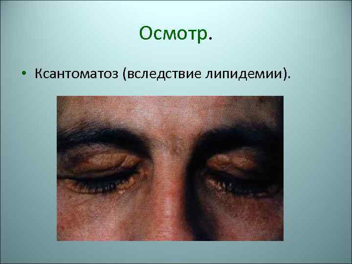 Осмотр. • Ксантоматоз (вследствие липидемии). 