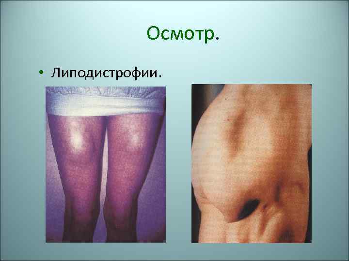 Осмотр. • Липодистрофии. 