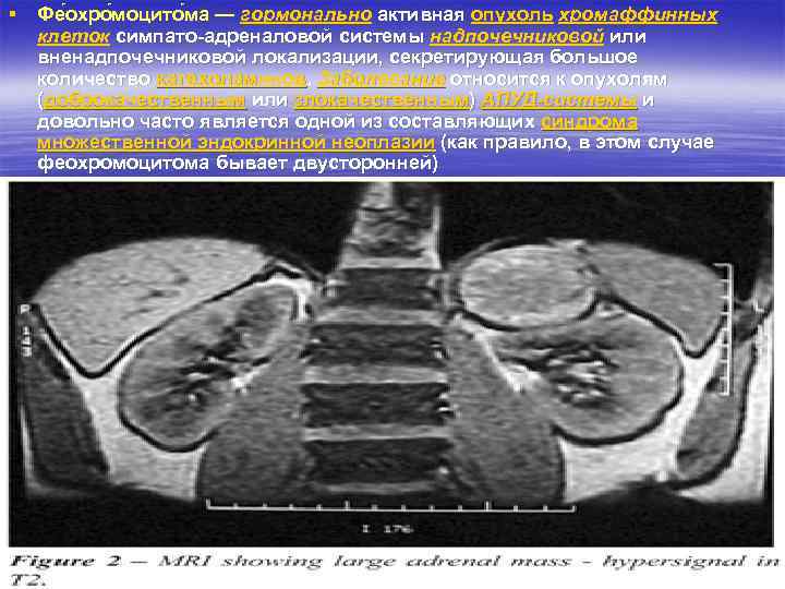 § Фе охро моцито ма — гормонально активная опухоль хромаффинных клеток симпато-адреналовой системы надпочечниковой