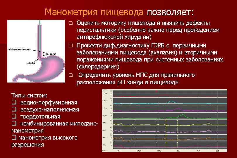 Манометрия пищевода позволяет: Оценить моторику пищевода и выявить дефекты перистальтики (особенно важно перед проведением