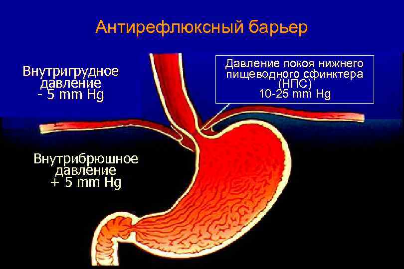 Антирефлюксный барьер Внутригрудное давление - 5 mm Hg Внутрибрюшное давление + 5 mm Hg