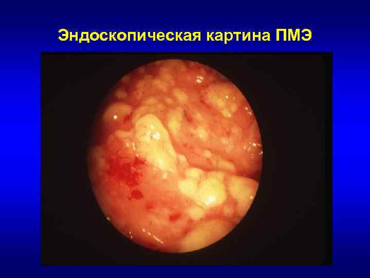 Эндоскопическая картина ПМЭ 