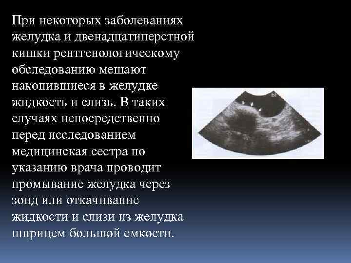 При некоторых заболеваниях желудка и двенадцатиперстной кишки рентгенологическому обследованию мешают накопившиеся в желудке жидкость