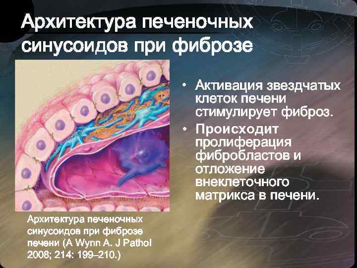 Архитектура печеночных синусоидов при фиброзе • Активация звездчатых клеток печени стимулирует фиброз. • Происходит
