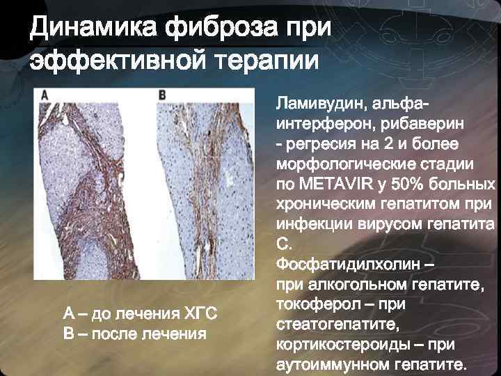 Динамика фиброза при эффективной терапии А – до лечения ХГС В – после лечения