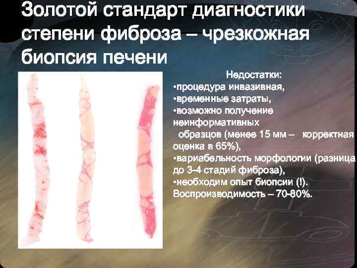 Золотой стандарт диагностики степени фиброза – чрезкожная биопсия печени Недостатки: • процедура инвазивная, •