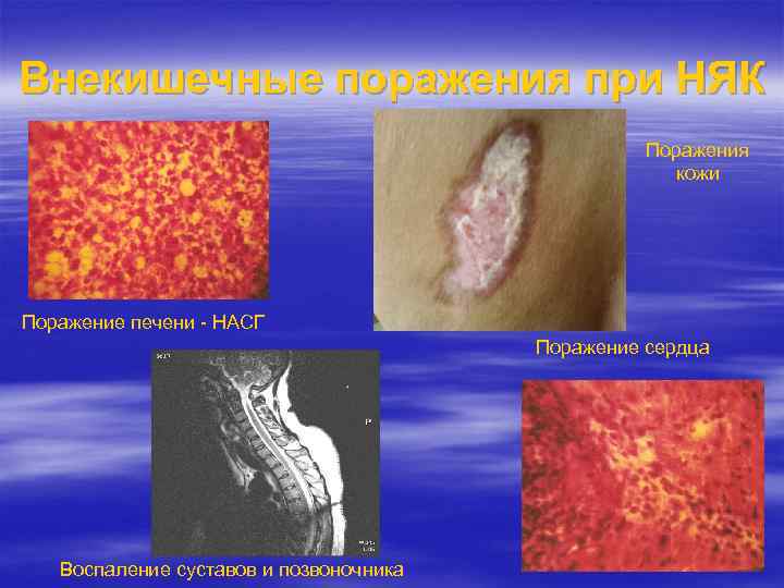 Внекишечные поражения при НЯК Поражения кожи Поражение печени - НАСГ Поражение сердца Воспаление суставов