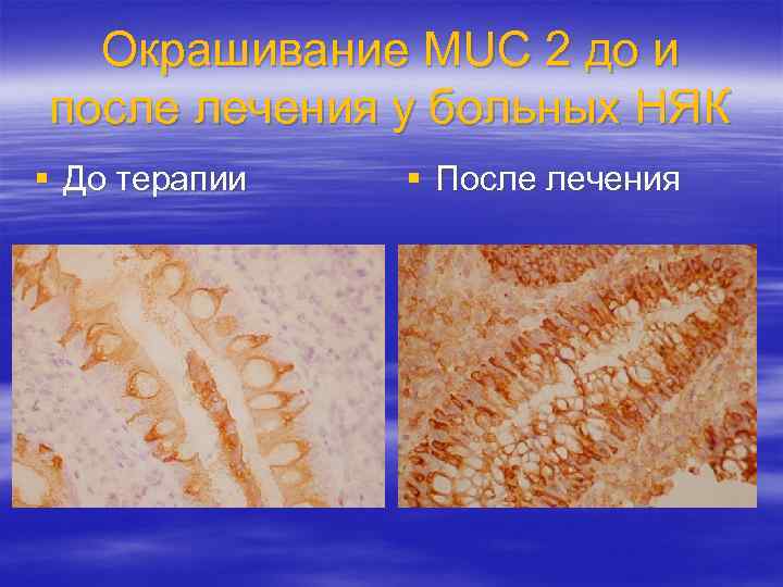 Окрашивание MUC 2 до и после лечения у больных НЯК § До терапии §