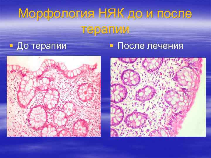 Морфология НЯК до и после терапии § До терапии § После лечения 