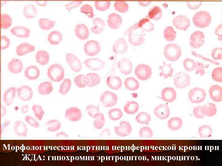 Морфологическая картина периферической крови при ЖДА: гипохромия эритроцитов, микроцитоз. 