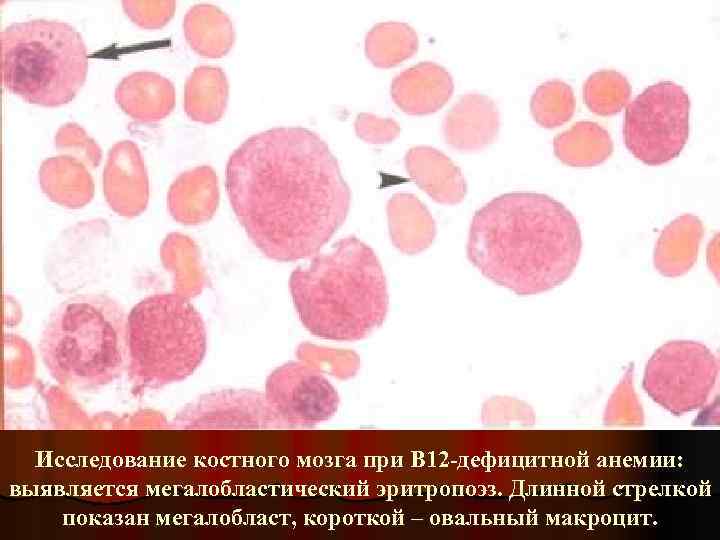 Исследование костного мозга при В 12 -дефицитной анемии: выявляется мегалобластический эритропоэз. Длинной стрелкой показан