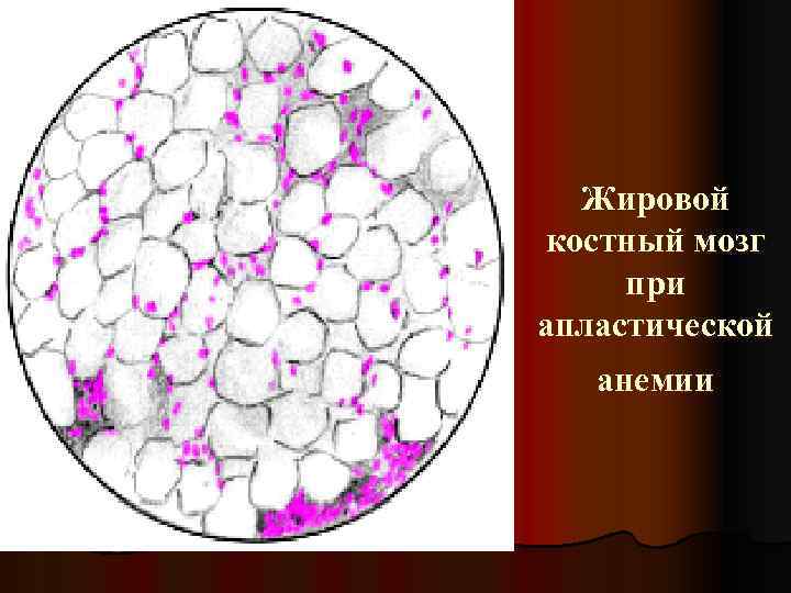 Жировой костный мозг при апластической анемии 