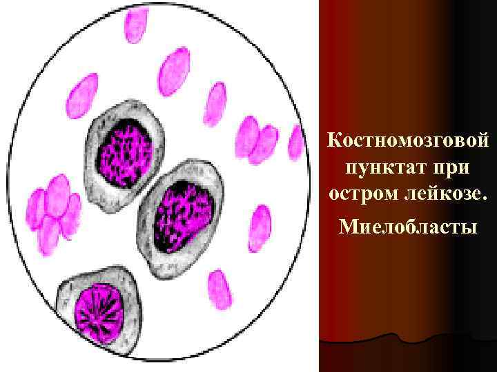 Костномозговой пунктат при остром лейкозе. Миелобласты 