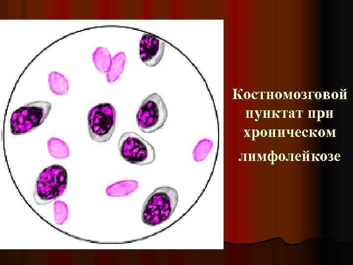 Костномозговой пунктат при хроническом лимфолейкозе 