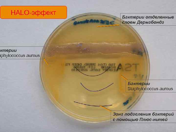 HALO-эффект Бактерии отделенные слоем Дермабонда ктерии aphylococcus aureus Бактерии Staphylococcus aureus Зона подавления бактерий