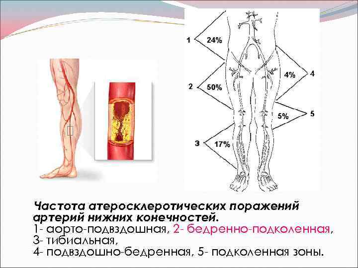 Частота атеросклеротических поражений артерий нижних конечностей. 1 - аорто-подвздошная, 2 - бедренно-подколенная, 3 -