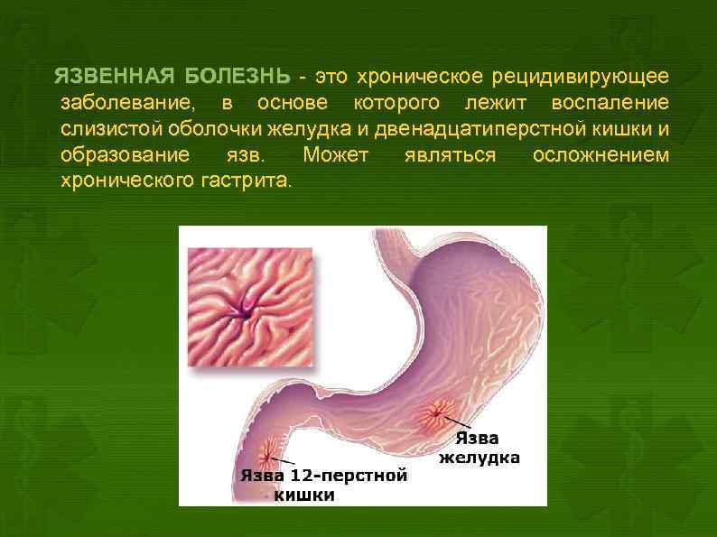 ЯЗВЕННАЯ БОЛЕЗНЬ - это хроническое рецидивирующее заболевание, в основе которого лежит воспаление слизистой оболочки