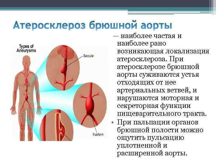 — наиболее частая и наиболее рано возникающая локализация атеросклероза. При атеросклерозе брюшной аорты суживаются