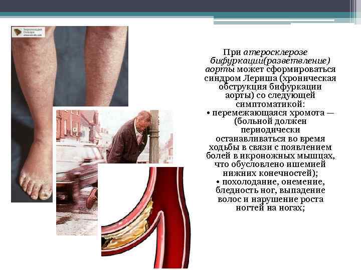 При атеросклерозе бифуркации(разветвление) аорты может сформироваться синдром Лериша (хроническая обструкция бифуркации аорты) со следующей