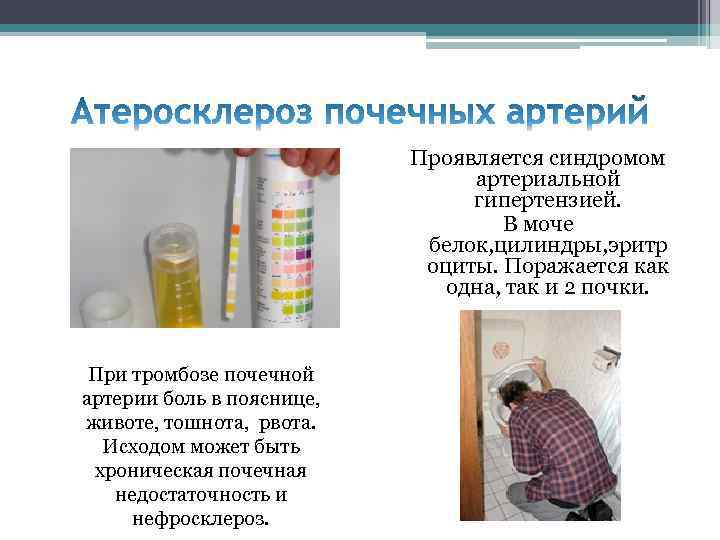 Проявляется синдромом артериальной гипертензией. В моче белок, цилиндры, эритр оциты. Поражается как одна, так