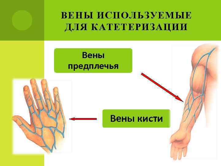 ВЕНЫ ИСПОЛЬЗУЕМЫЕ ДЛЯ КАТЕТЕРИЗАЦИИ Вены предплечья Вены кисти 