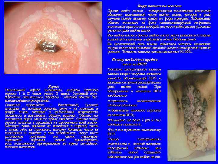 Вирус папилломы человека Эрозия шейки матки – поверхностное изъязвление слизистой оболочки влагалищной части шейки