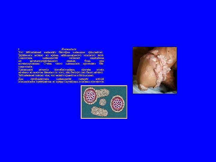  • Хламидиоз Это заболевание вызывает бактерия хламидия трахоматис. Заразиться можно во время незащищенного