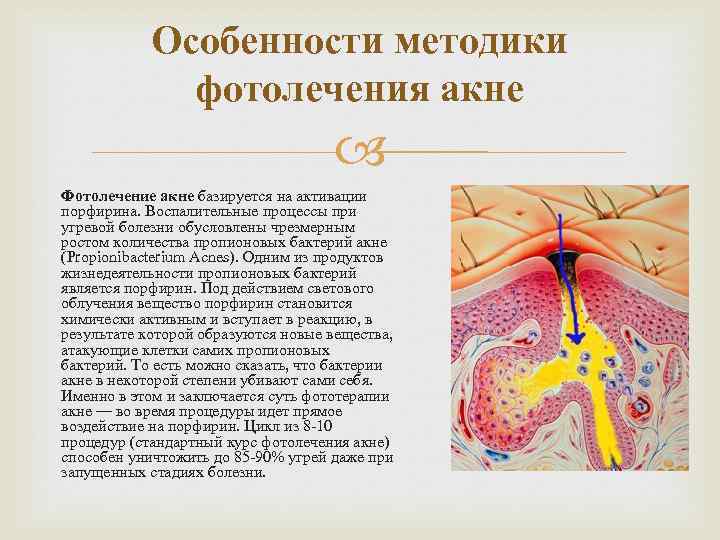 Особенности методики фотолечения акне Фотолечение акне базируется на активации порфирина. Воспалительные процессы при угревой