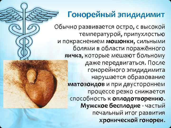 Гонорейный эпидидимит Обычно развивается остро, с высокой температурой, припухлостью и покраснением мошонки, сильными болями
