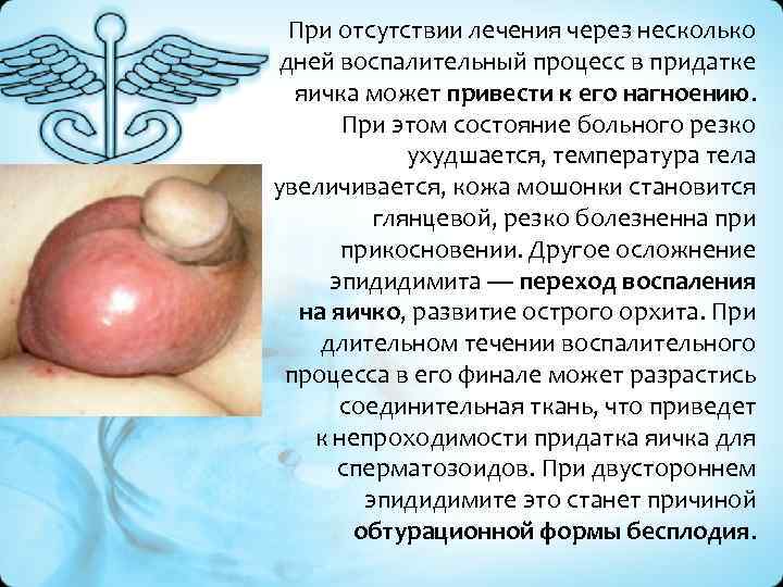 При отсутствии лечения через несколько дней воспалительный процесс в придатке яичка может привести к