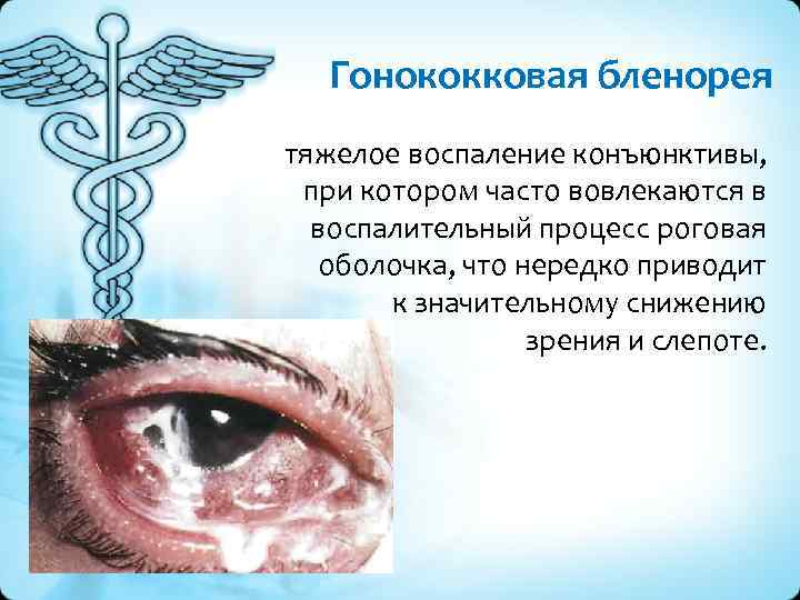 Гонококковая бленорея тяжелое воспаление конъюнктивы, при котором часто вовлекаются в воспалительный процесс роговая оболочка,