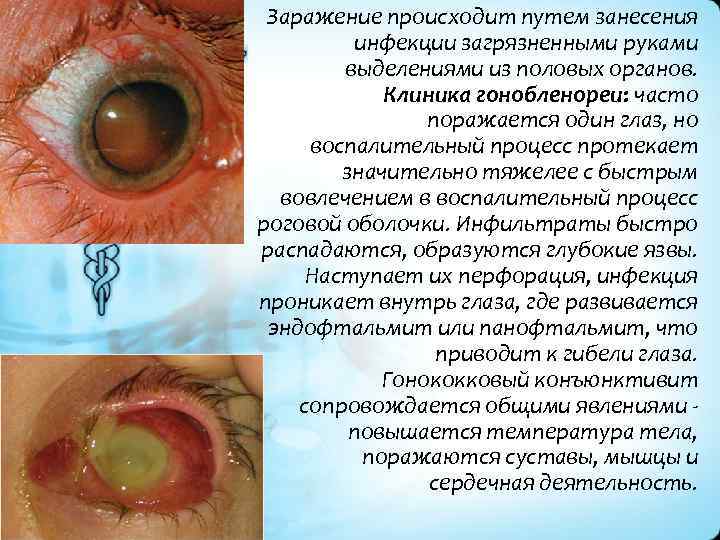 Гонококковая инфекция презентация