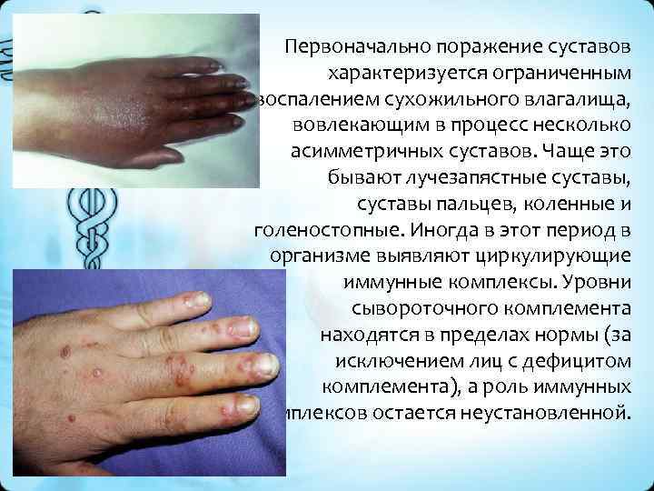 Первоначально поражение суставов характеризуется ограниченным воспалением сухожильного влагалища, вовлекающим в процесс несколько асимметричных суставов.