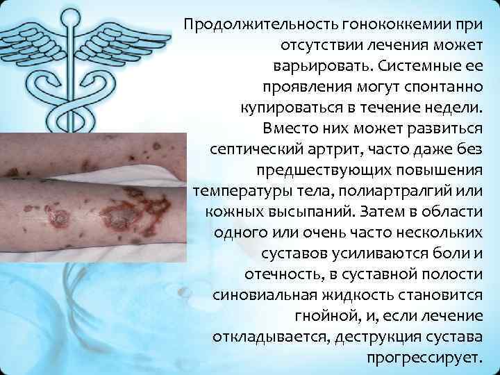 Продолжительность гонококкемии при отсутствии лечения может варьировать. Системные ее проявления могут спонтанно купироваться в