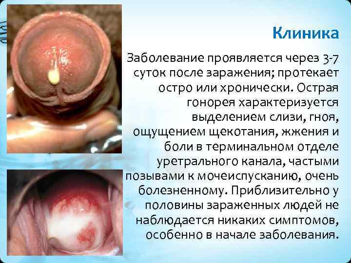 Клиника Заболевание проявляется через 3 -7 суток после заражения; протекает остро или хронически. Острая