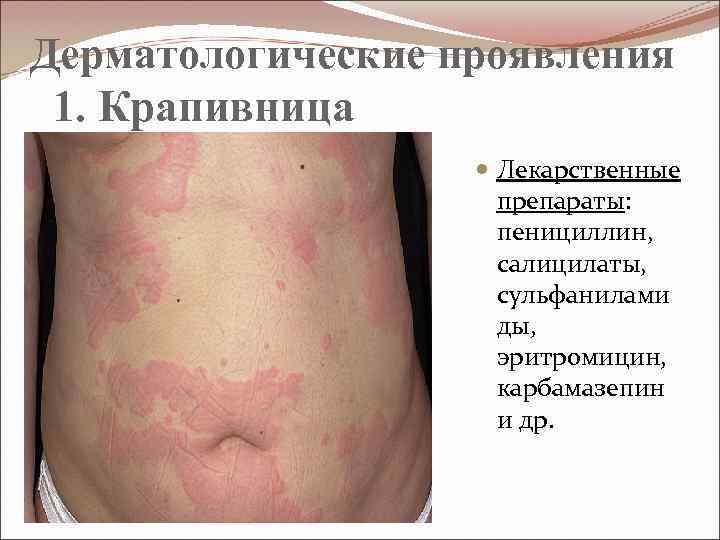 Дерматологические проявления 1. Крапивница Лекарственные препараты: пенициллин, салицилаты, сульфанилами ды, эритромицин, карбамазепин и др.