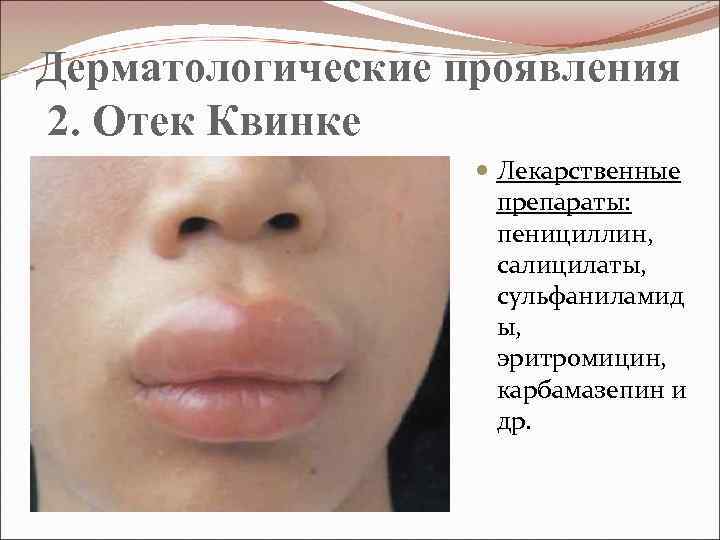 Дерматологические проявления 2. Отек Квинке Лекарственные препараты: пенициллин, салицилаты, сульфаниламид ы, эритромицин, карбамазепин и