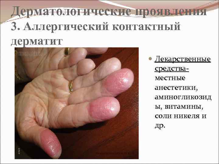 Дерматологические проявления 3. Аллергический контактный дерматит Лекарственные средства- местные анестетики, аминогликозид ы, витамины, соли