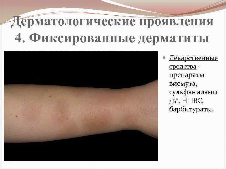 Дерматологические проявления 4. Фиксированные дерматиты Лекарственные средства- препараты висмута, сульфанилами ды, НПВС, барбитураты. 